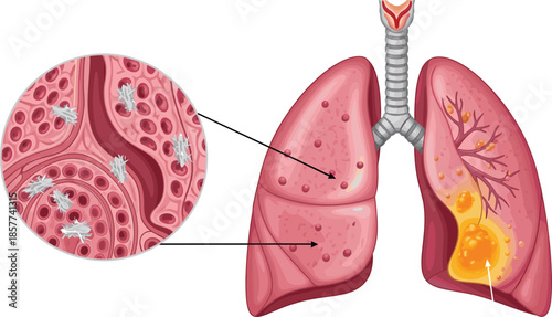 Human lungs anatomy illustration showing healthy tissue and infected lung area with microscopic bacteria medical concept