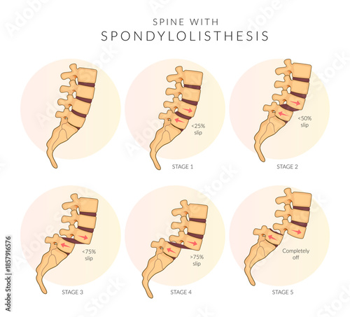 Spondylolisthesis Stage 1 to 5 - Spinal Joints - Stock Illustration
