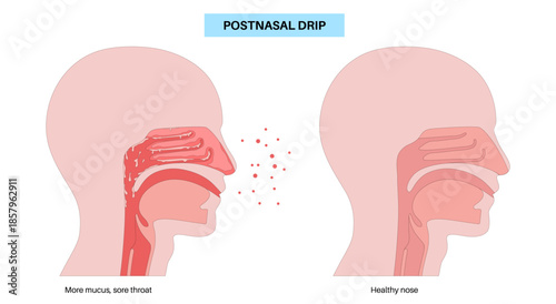 Postnasal drip poster