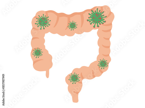 Intestinal Infection Disease in Colon or Intestines
