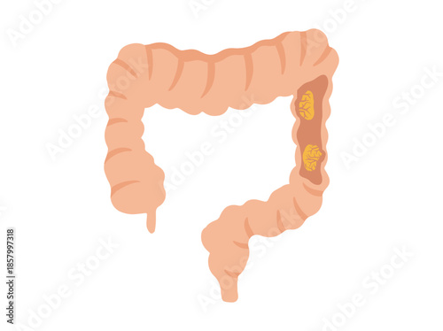 Colorectal Cancer in Intestines Illustration

