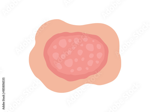 Nummular Eczema Disease Clip Art
