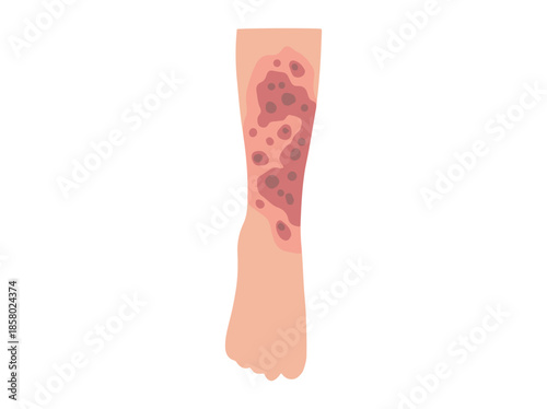 Neurodermatitis Disease Clip Art Illustration
