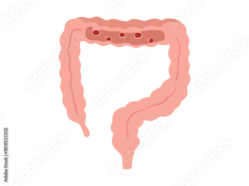 Hand Drawn Intestinal Polyps Disease
