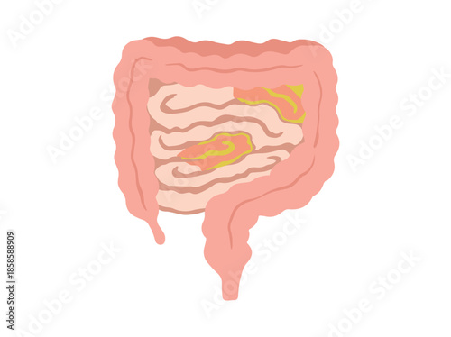 Enteritis Disease in Intestines Illustration