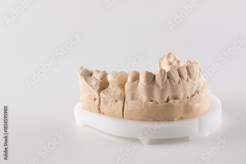 dental crown made of ceramics