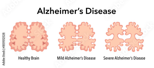 Alzheimer's disease stages. Human brain cross section, affected with progressive neurodegenerative disease. Damaged neuron with amyloid plaques vector illustration