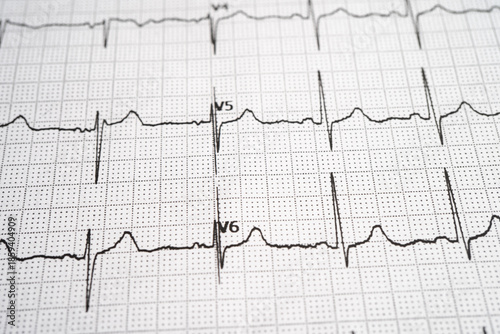 Red heart on electrocardiogram ECG with red heart, heart wave, heart attack, cardiogram report.