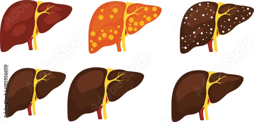 Human liver anatomy illustration set showing healthy and diseased stages, medical educational organ vector isolated on white