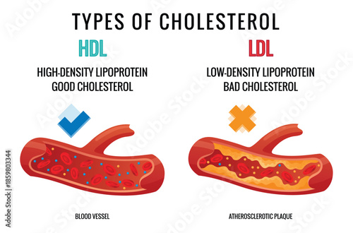 Types of cholesterol in human blood vessels. Normal and narrowed artery for explanation diseases. High-Density Lipoprotein HDL and Low-Density Lipoprotein LDL. Vector illustration