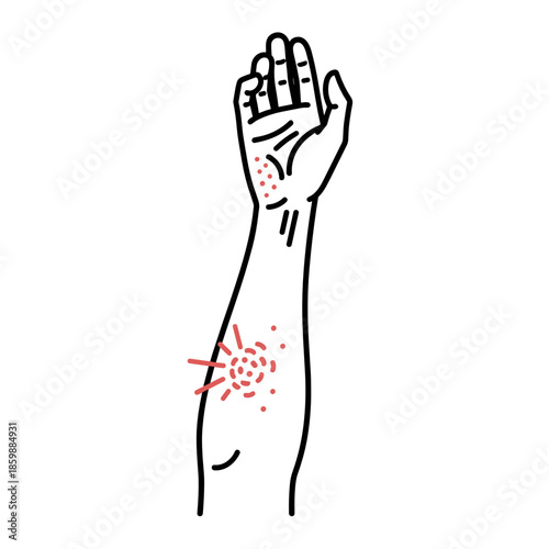 Human arm covered in red rash and hives for allergy symptoms and dermatological skin problem concept