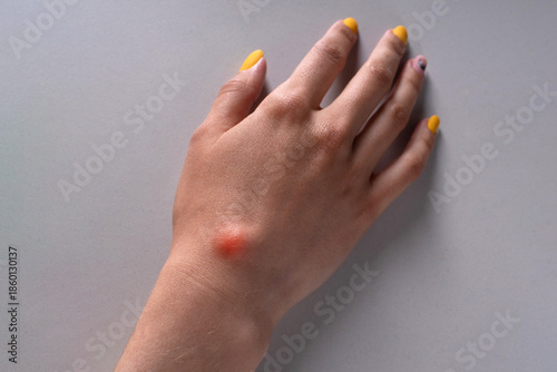 Fotografie Ganglion cyst on woman hand on white background
