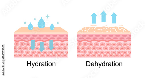 The mechanism of hydration and dehydration skin layer vector illustration on white background. Comparison of skin absorb water, moisture and dry skin lacks water in the uppermost layer.