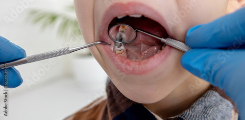 Canvas Print A dentist examines a child's tooth cavities using a mirror and probe