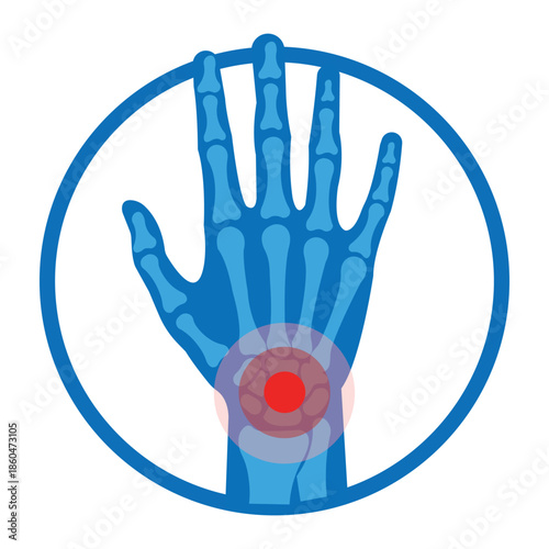 Painful Wrist: Medical illustration of a hand revealing a painful wrist, ideal for healthcare and medical content. Depicting the anatomical structure of the hand.