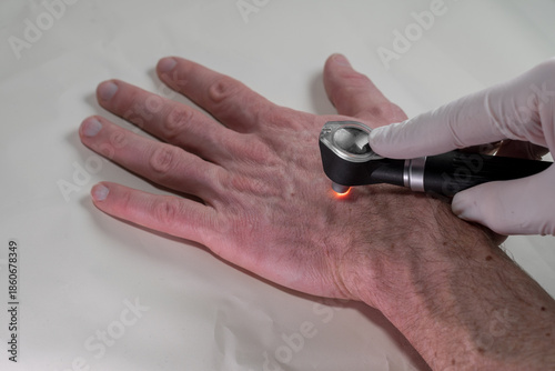 Dermatologist performing dermoscopy examination on male hand with dermatoscope, close-up skin cancer screening for melanoma prevention and early detection medical check. Mole control.