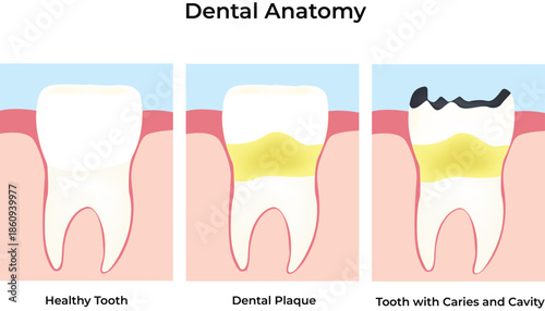 Dental Anatomy Healthy Tooth Plaque and Cavity Progression