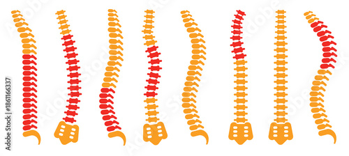 comparing different human spine shapes with correct 