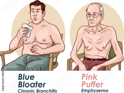 blue bloater vs pink puffers stock  vector illustrationchronic 