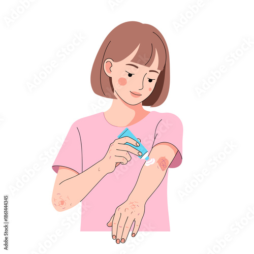 Young woman applying cream to eczema on her elbows indoors  