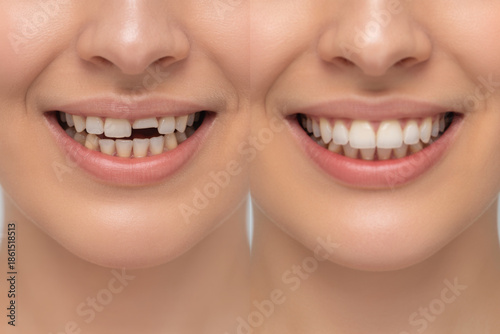 Collage of woman with diastema between upper front teeth before after treatment,showing big gap crack,older middle aged female needs stomatology dentist,medicine healthcare close up. 