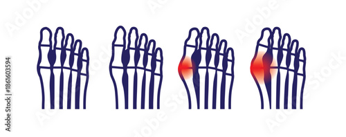 Hallux Valgus Feet X-Ray Cartoon Vector Illustration