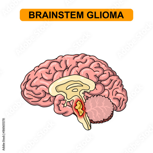 Illustration of Brainstem glioma. Tumor, cancer in the human brain. Illustration of brain disease. Vector nerve illustration for medical concept, poster, diagram, science or health element infographic