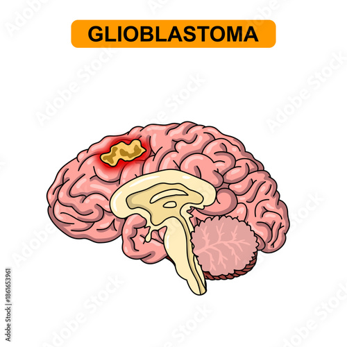 Illustration of glioblastoma . Tumor, cancer in the human brain. Illustration of brain disease. Vector nerve illustration for medical concept, poster, diagram, science or health element infographic