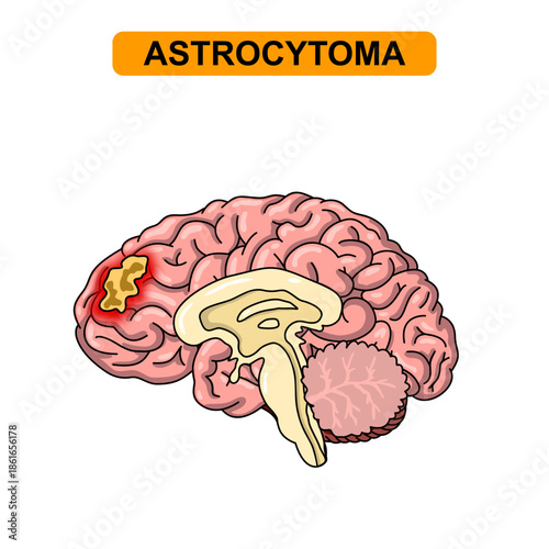 Illustration of astrocytoma. Tumor, cancer in the human brain. Illustration of brain disease. Vector nerve illustration for medical concept, poster, diagram, science or health element infographic