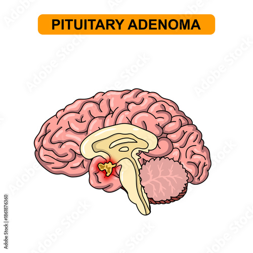 Illustration of pituitary adenoma. Tumor, cancer in the human brain. Illustration of brain disease. Vector nerve illustration for medical concept, poster, diagram, science or health element