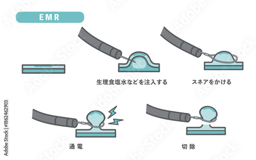 内視鏡的粘膜切除術（EMR）の手順・図解イラスト