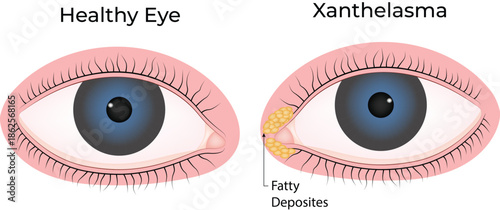 Xanthelasma Healthy Eye vs. Fatty Deposits Comparison
