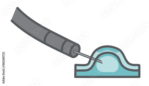 EMRの局所注入（生理食塩水で粘膜を膨らませる）のイラスト