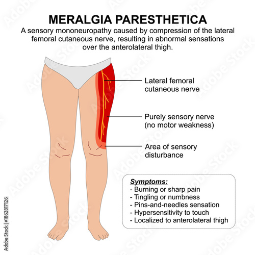 Meralgia Paresthetica infographic flashcard illustration