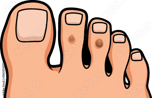 Close-up illustration of a human foot with five toes, some showing warts