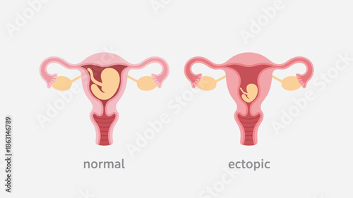 Informative medical diagram showing a healthy pregnancy in the uterus versus an ectopic gestation in the fallopian tube