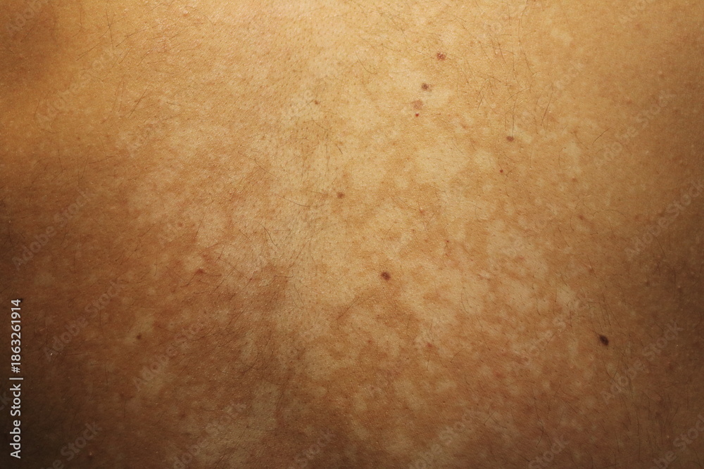 Fototapeta premium Tinea Versicolor on the Back with Hypopigmented Skin Patche