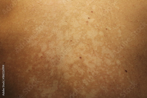 Tinea Versicolor on the Back with Hypopigmented Skin Patche