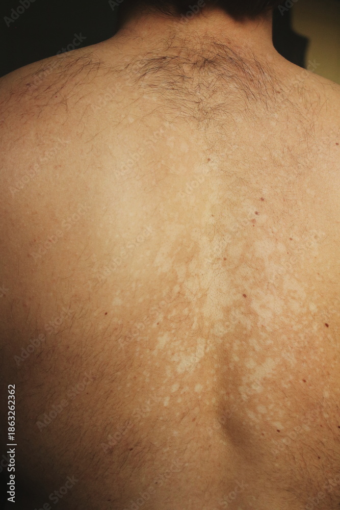 Fototapeta premium Tinea Versicolor on the Back with Hypopigmented Skin Patche