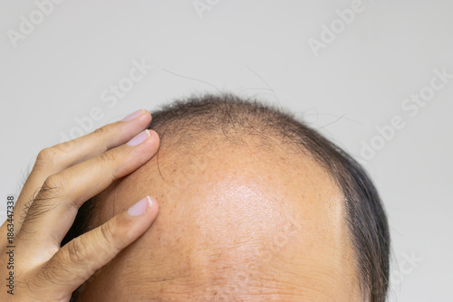 薄毛の男性の頭と手（日本人、30代）