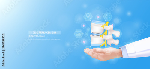 Disc replacement model in doctor hand. Vertebra bone joint surrounded by medical icons. Technologies in science health care. Realistic 3D Vector.