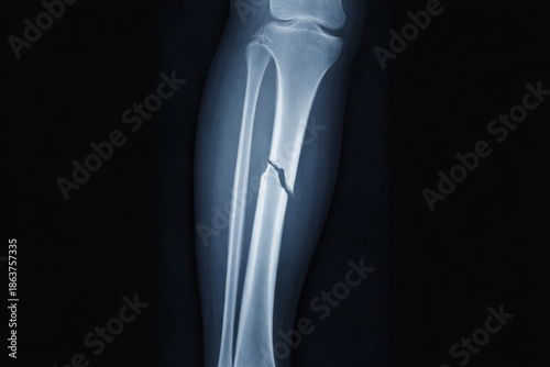 X-ray image of lower leg bone fracture isolated on black background