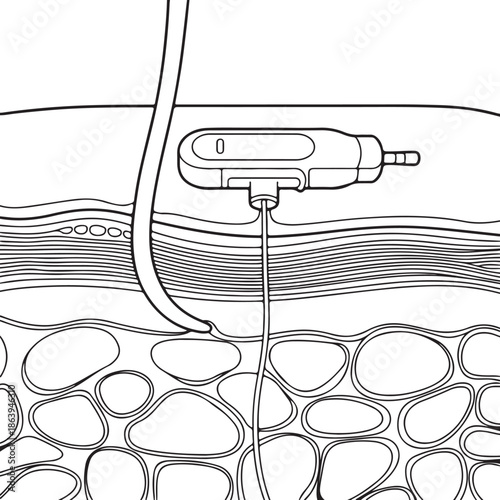 Under the skin flat black vector line art, skin, CGM sensor and the tiny interstitial fluid outline