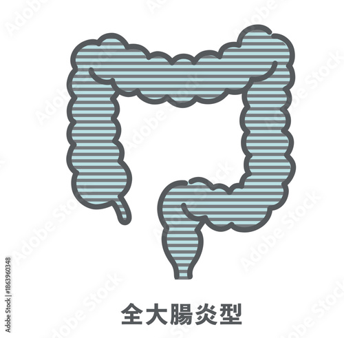 潰瘍性大腸炎・全大腸炎型のイラスト（病変範囲）