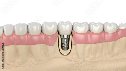Bild auf Leinwand Anatomy of a dental implant a visual guide to tooth replacement in the jawbone s
