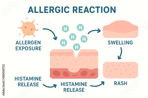 Allergic reaction process: allergen exposure, histamine release, swelling, rash