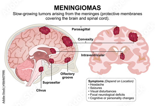 Menigiomas infographic flashcard brain tumor
