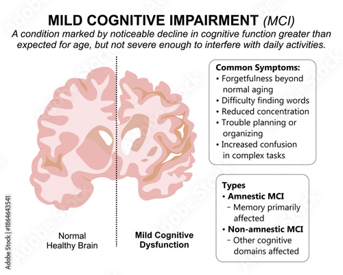 Mild Cognitive Impairment (MCI) Brain Flashcard
