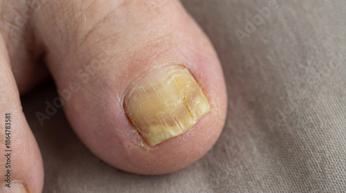 A yellowish, thickened toenail hints at a deeper issue; the toe presents with possible signs of a fungal nail infection, also called onychomycosis, showcased in clinical detail.