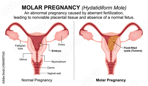 Molar Pregnancy (Hydatidiform Mole) flashcard